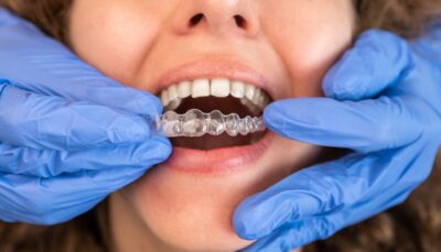 invisalign West Hollywood