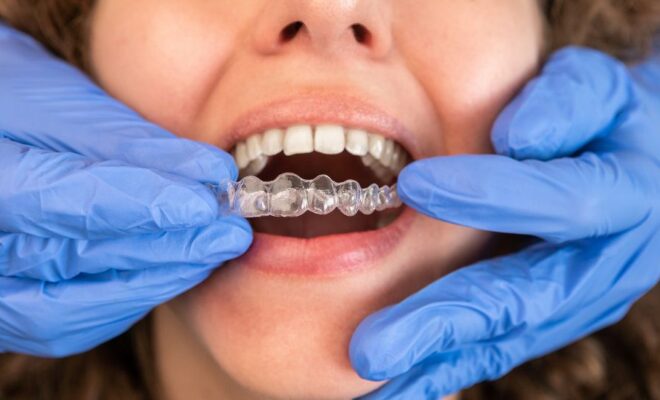 invisalign West Hollywood